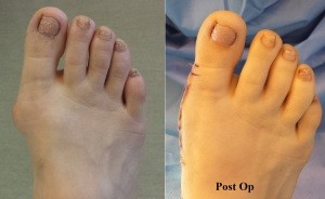 Pre and Post op Bunion Surgery in Mission Viejo