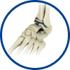 Ankle Joint Replacement in the Irvine, CA 92618, Huntington Beach, CA 92648, Orange, CA 92868 and Newport Beach, CA 92663 areas