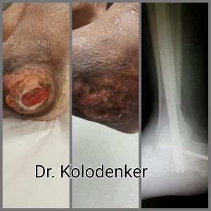 Ankle Ulcer Closed - before and after