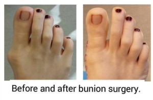 Bunion Surgery Orange County