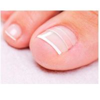 Curve Correct for curved or ingrown nail