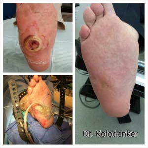 Diabetes Charcot Foot Ulcer Surgery Healed and Closed