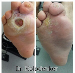 Diabetic Foot Ulcer Care
