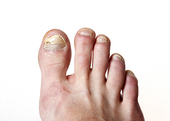 Halvtreds skive Mold The Different Types of Toenail Fungus