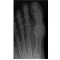 Hallux Limitus – Joint arthritis is seen