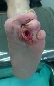 Open Diabetic Foot Ulcer