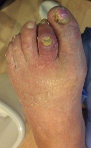 Open Toe Ulcer Management