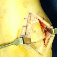 Painful big toe joint pain relieved after cheilectomy. The joint is more rounded and functions more comfortably.