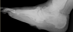 X-ray of Charcot Foot