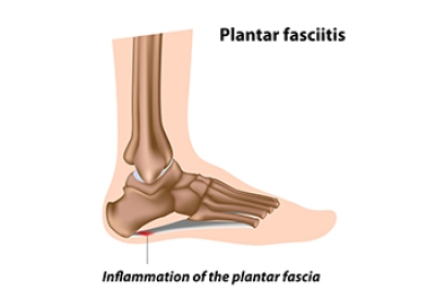 Symptoms and Causes of Plantar Fasciitis