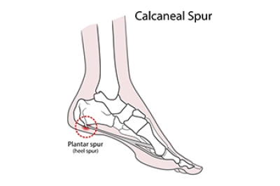 Why Do I Have A Heel Spur?